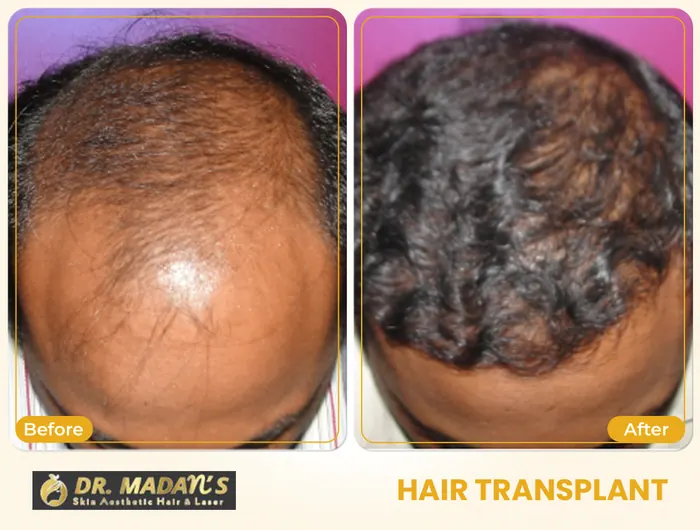 Hair transplant before and after result 4 at Dr Madan Aesthetics